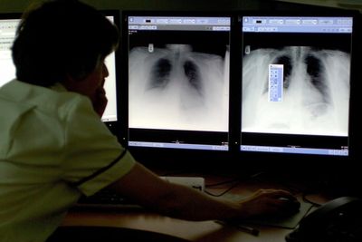 Daily pill for lung cancer to be made routinely available on the NHS