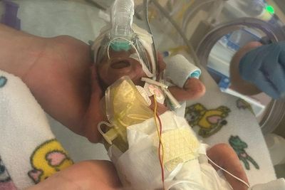 Parents praise medical staff for saving daughter born weighing just one pound