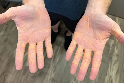 Man's Hands Seemingly Turn Yellow After Only Eating Butter, Cheese and Meat in Viral 'Carnivore Diet'