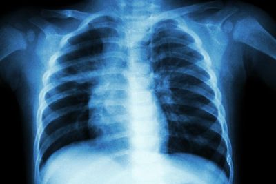 Kansas officials say tuberculosis outbreak is largest on record in US history