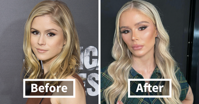 “Looked Better Before”: 17 Stars People Say Look Unrecognizable After Plastic Surgery