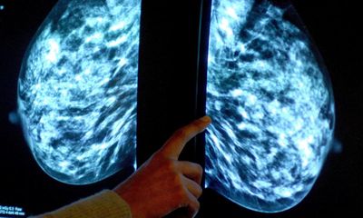 NHS to launch world’s biggest trial of AI breast cancer diagnosis