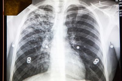 Kansas reckons with large tuberculosis outbreak as health officials hamstrung