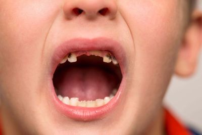 Amount of five-year-olds with rotting teeth rising in parts of England – data