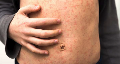 Measles Outbreak in Texas County With Low Vaccination Rate Multiplies, More Cases 'Likely'