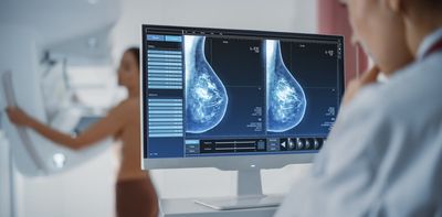 Having dense breasts is linked to cancer. But advice about breast density can depend on where you live