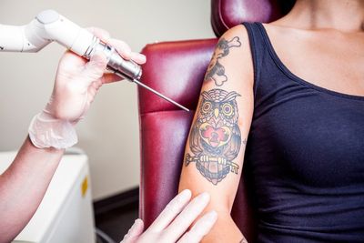 What it really feels like to get your unwanted tattoos removed