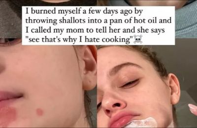 Joey King shares update on her recovery after burns incident