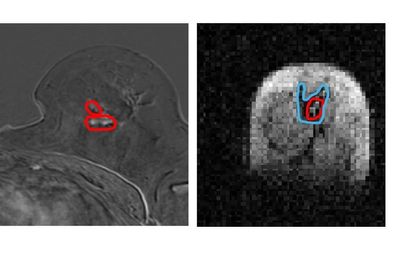 New scanner can see ‘previously undetectable’ cancer spread, research suggests