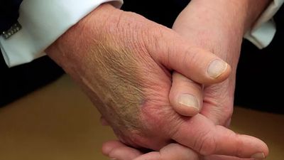 Doctors Debate If Trump's Mysterious Bruise on His Hand Could Be Caused By His 'Aggressive Handshake'