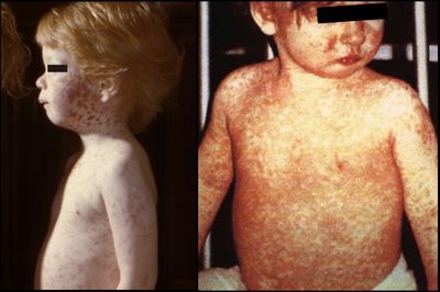 Unvaccinated Child Becomes First in a Decade to Die of Measles as Texas Outbreak Grows