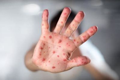 Measles Outbreak In West Texas Claims First US Death In A Decade: Symptoms To Watch Out For