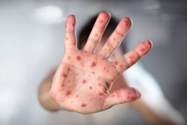 Measles Outbreak In West Texas Claims First US Death In A Decade: Symptoms To Watch Out For