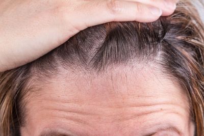 Why your hair is thinning and how to fix it, according to the experts