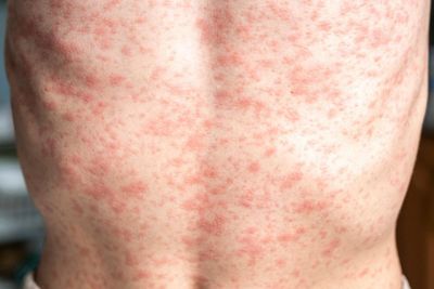 Measles outbreak: how contagious is it and what are the symptoms?