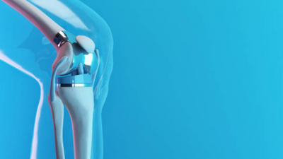 Are you considering knee replacement surgery? Here are 10 things you should know