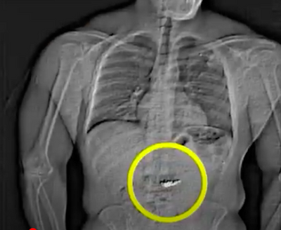 Florida Man's X-Rays Reveal $769K of Jewelry Swallowed During Botched Robbery: 'Should Have Thrown Them Out the Window'