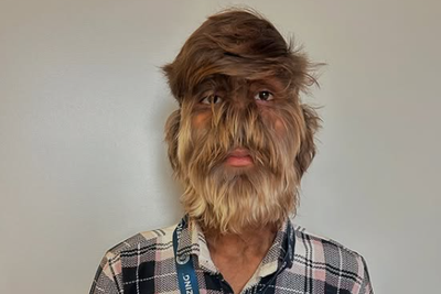 Boy with 95 per cent of face covered in hair sets Guinness World Record