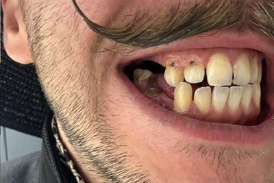 Man with dental phobia faces £25,000 bill to fix teeth after they ‘crumbled away’
