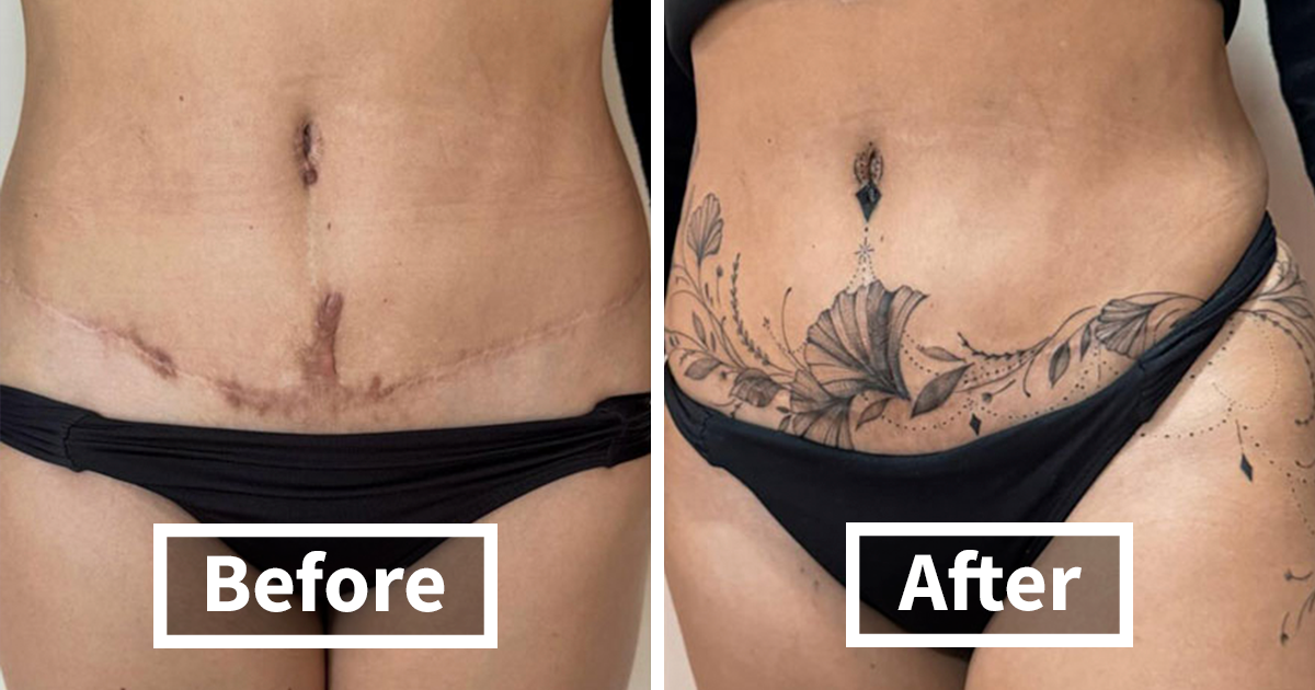 Tattoo Artist Covers Scars With Delicate Designs, And…