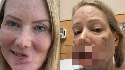 Woman's Lip Found 'Chewed Up' on the Floor After Savage Labrador Attack in a Restaurant