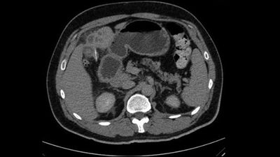 Diagnostic dilemma: A fish bone wandered through a man's abdomen and stabbed his liver