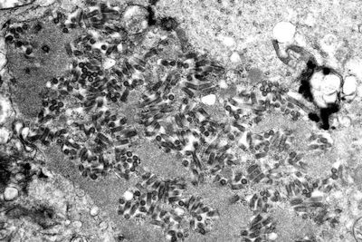 Organ transplant patient in Michigan dies from rabies