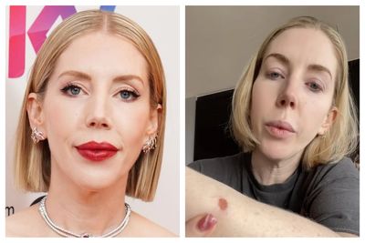 Katherine Ryan left shocked by surprise £6,000 bill after skin cancer test
