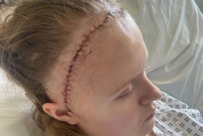 Miracle recovery for girl after part of skull stored in her stomach