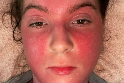 Young woman ‘would do anything to have eczema again’ after steroid withdrawal