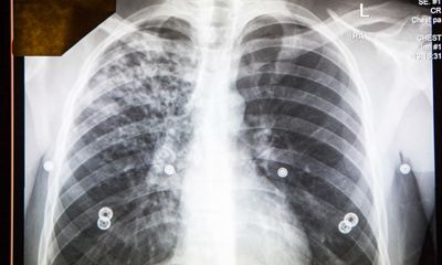 Tuberculosis could end if there’s more US public health funding, experts say