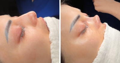 “Not Having Money Protects Me From A Lot”: People Stunned At “Botched” Nose Job In Viral Video