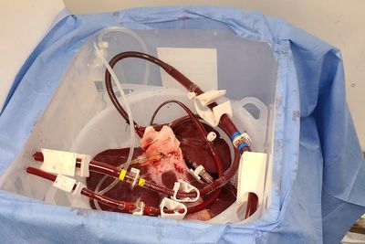 FDA OKs trial of pig livers as dialysis-like treatment for liver failure