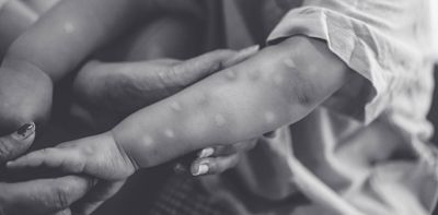 The world could stop central Africa’s deadly mpox outbreak if it wanted to