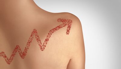 Do You Need a Measles Booster? You Might Be Surprised