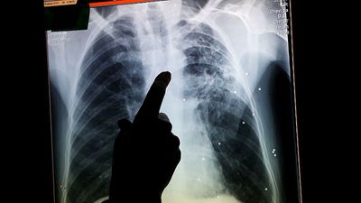 Why is tuberculosis, the world's deadliest infectious disease, on the rise in the UK?