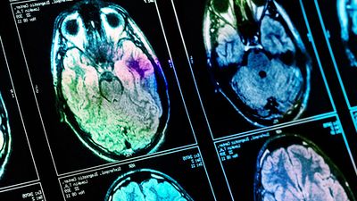 Stroke Management Drug Firm Climbs To Key Level Ahead Of Earnings; But Beware This Pharma Tariff