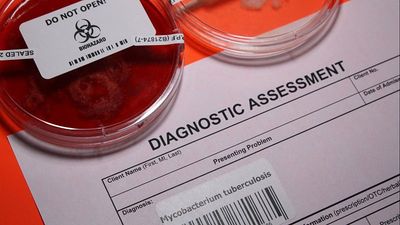 European countries are falling short on fight against HIV, TB and STIs, health authorities warn