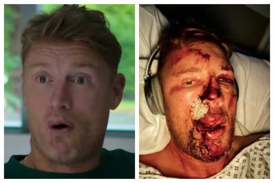 Freddie Flintoff reveals graphic injuries from Top Gear crash after ‘thinking face had been ripped off’