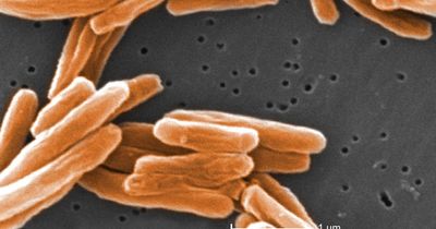 Case of tuberculosis confirmed at Scottish school