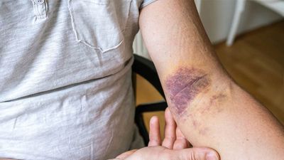 Unexplained Bruises? It Could Be a Hidden Sign of Blood Cancer, Experts Warn