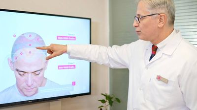 DK Klinik Develops Hair Donor Index After Thousands of Clinical Cases