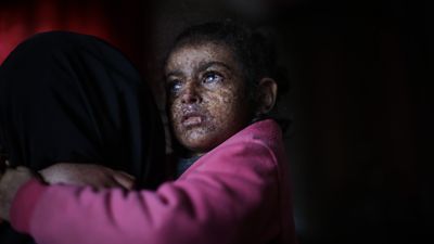 What is xeroderma pigmentosum? The rare genetic disorder that forces people to avoid sunlight