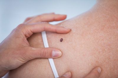 Warning signs of melanoma and how to tell if a spot is cancerous