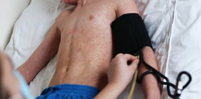 What are the symptoms of measles? How long does the vaccine last? Experts answer 6 key questions