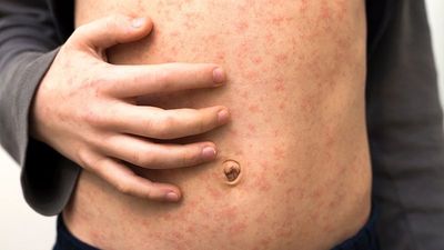 Measles in Europe: Where are cases of one of the world's most contagious diseases on the rise?