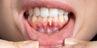 From vigorous brushing to clear aligners, here’s what might be causing your gums to recede