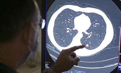 NHS in England urged to become ‘early intervention service’ on cancer