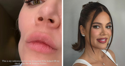 “Horribly Stitched”: Khloe Kardashian Posts Unsettling Pictures Of Her Plastic Surgery