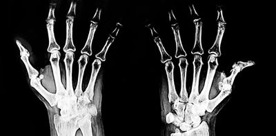 What’s the difference between osteoarthritis and rheumatoid arthritis?